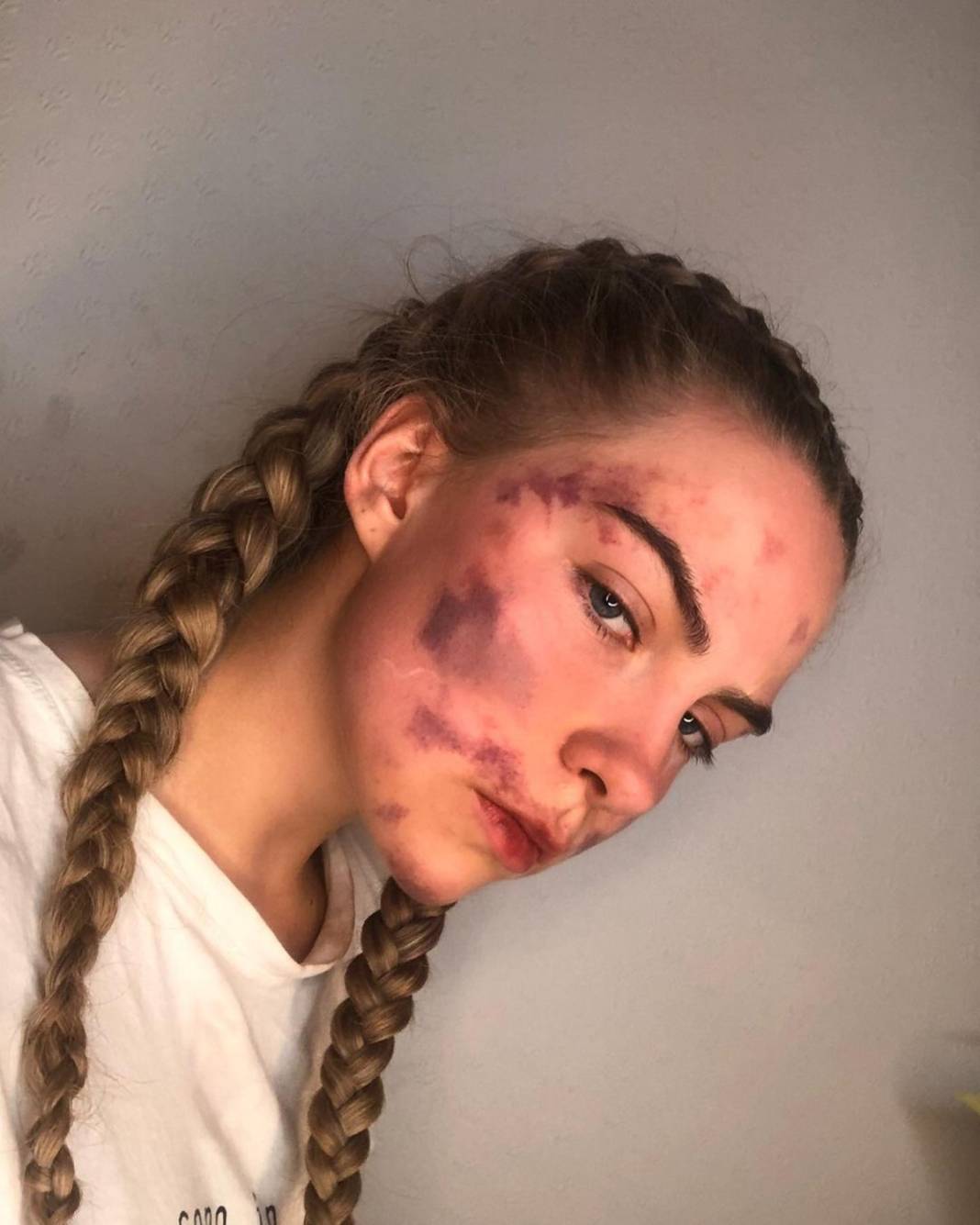 Basit bir uçuk zannetti, korkunç hastalığa yakalandı! Doktorlar bile teşhis koyamadı 16